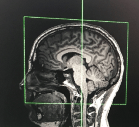 Butler- TMS Brain Scan 1