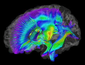 Butler- TMS Brain Scan 2