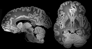 Butler- TMS Brain Scan 3