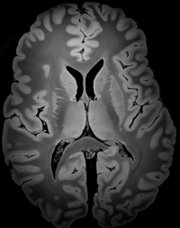 Butler- TMS Brain Scan 4