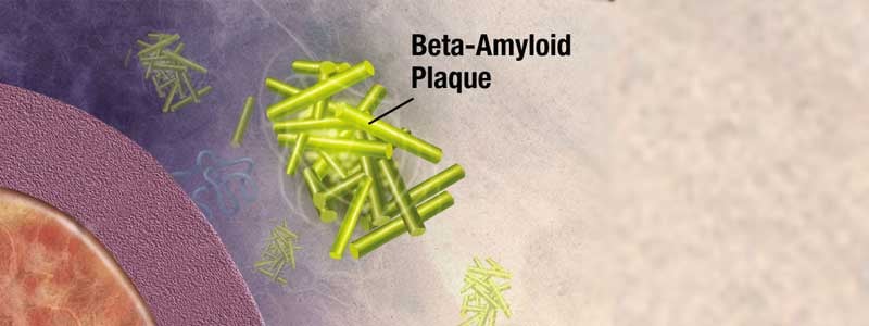 illustration of beta amyloid plaques