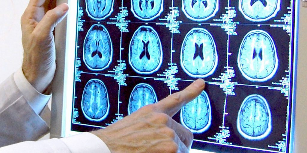 Dr. Stephen Salloway of the Memory and Aging Program at Butler Hospital points at brain scan images that show changes in the brain associated with the development of Alzheimer's disease.
